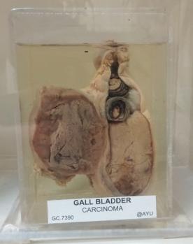 GALLBLADDER